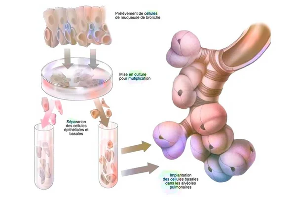 Culture Bronchial Stem Cells Implantation Pulmonary Alveoli — ストック写真
