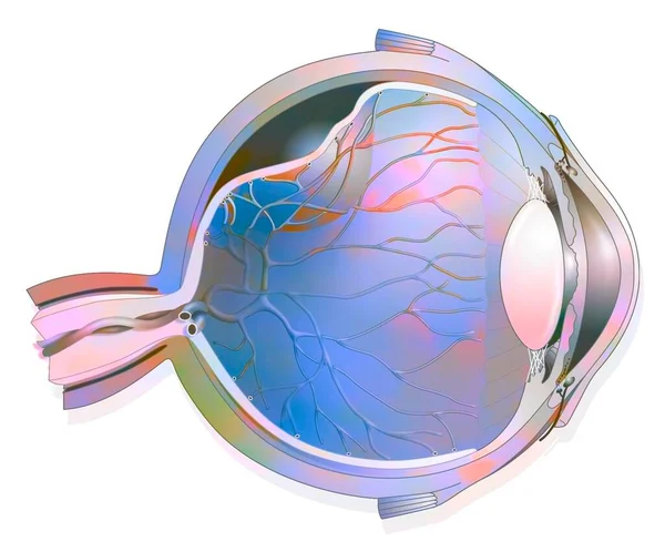 Eye Detachment Retina Which Detaches Underlying Choroid — Stock Photo, Image