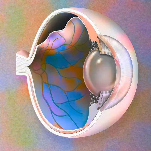 Eye Detachment Retina Which Detaches Underlying Choroid — ストック写真