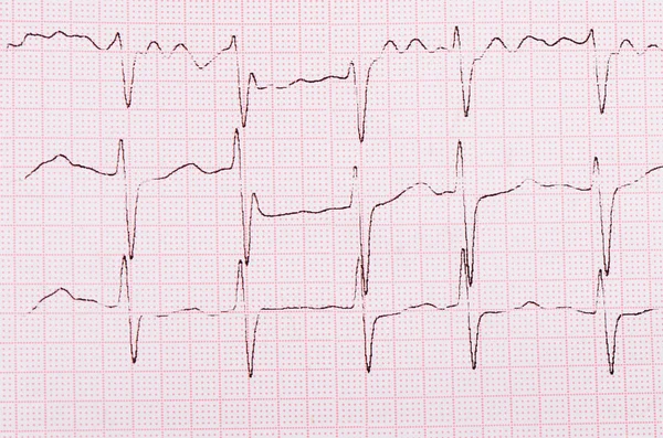 Il nastro con il cardiogramma di un uomo — Foto Stock