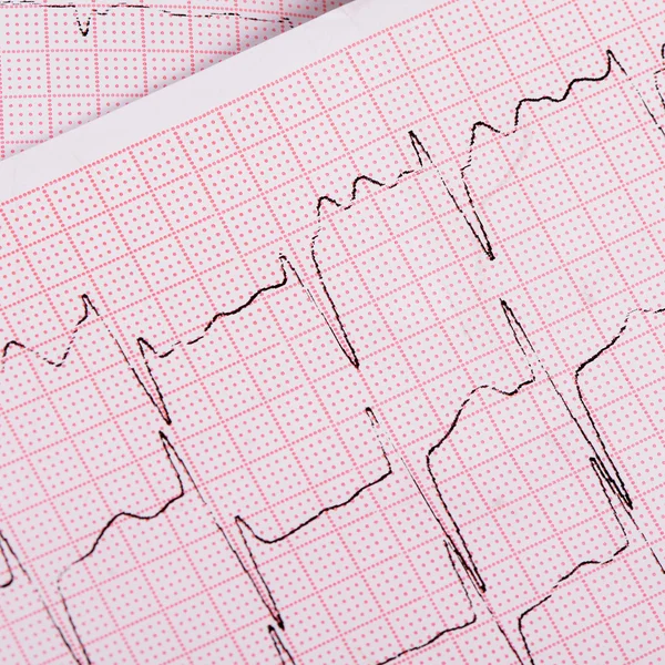 Bandet med cardiogram av en man — Stockfoto