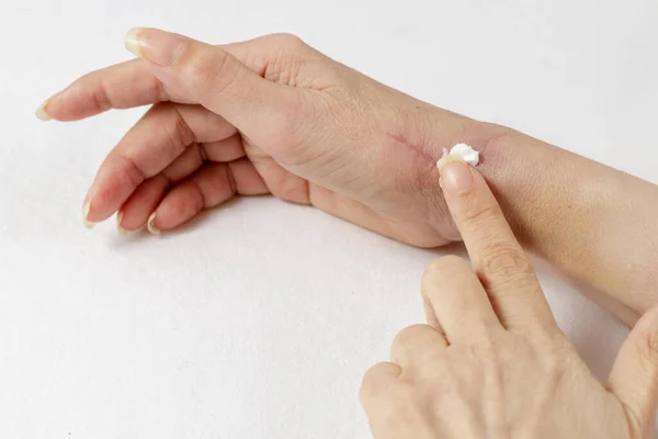 Bir kadının elindeki tendon ameliyatından sonra özel bir tıbbi krem sürmek ya da iyileşme yarasına merhem sürmek. Esneklik için yara bakımı.
