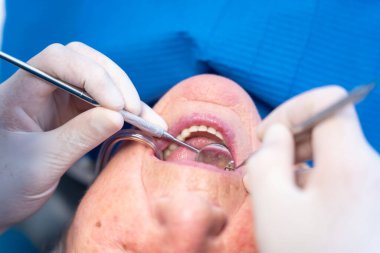 Diş kliniği, yaşlı bir kadının dişlerini kontrol eden bir doktorun elleri.