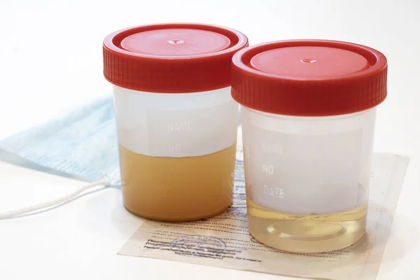 Uringläser Auf Weißem Hintergrund Gute Und Schlechte Urinanalyse Einwegbehälter Zur Stockbild