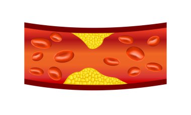 atherosclerosis  banner, vector illustration clipart