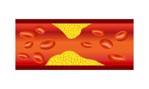 Atherosclerosis Banner Vector Illustration — Stock Vector