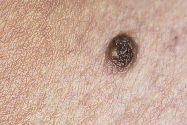 Mole on human skin — Stock Photo, Image