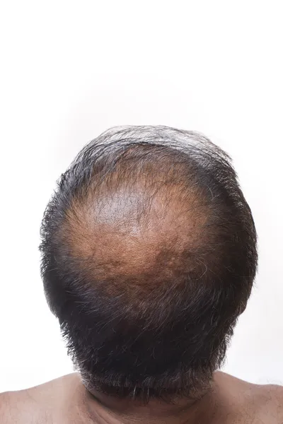 Hair loss — Stock Photo, Image