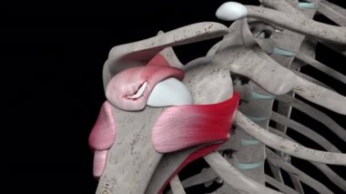 Bu 3D animasyon omuz ameliyatını gösteriyor. Pervane manşetinin I şeklindeki yırtığının köşe dikişiyle.