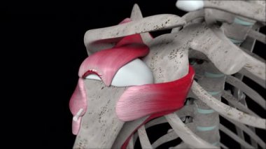 Bu 3 boyutlu animasyon omuz ameliyatını rotatör manşetindeki küçük hilal yırtığının bir çapa dikişiyle gösteriyor.