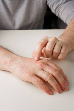 Yanlış diyetten ya da ilaçlardan kaynaklanan alerji reaksiyonlu eller. Dermatoloji, yan etki. Hasta işaret parmağıyla cildindeki kırmızı noktaları gösteriyor.