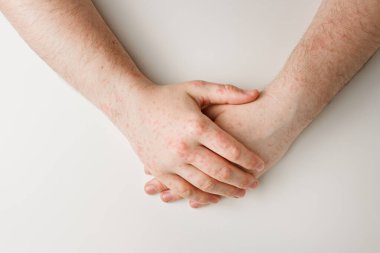 Erkek elleri beyaz masada, derisinde kırmızı lekeler var. Alerjik reaksiyon, deri problemleri, cilt bakımı. Yanlış diyet, ilaç almanın yan etkisi.