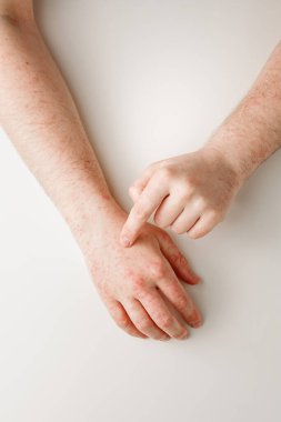 Yanlış diyetten ya da ilaçlardan kaynaklanan alerji reaksiyonlu eller. Dermatoloji, yan etki. Hasta işaret parmağıyla cildindeki kırmızı noktaları gösteriyor.