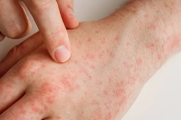 Yanlış diyetten ya da ilaçlardan kaynaklanan alerji reaksiyonlu eller. Dermatoloji, yan etki. Hasta kırmızı noktalar cilt üzerinde işaret parmağıyla, yakın çekim
