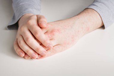 Cildinde kırmızı lekeler olan erkek eller. Mevsimsel alerji, alerjik yiyecekler yüzünden diyabet, antibiyotik almanın sonuçları. Gri kollu kollar