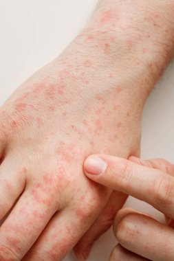Yanlış diyetten ya da ilaçlardan kaynaklanan alerji reaksiyonlu eller. Dermatoloji, yan etki. Hasta kırmızı noktalar cilt üzerinde işaret parmağıyla, yakın çekim