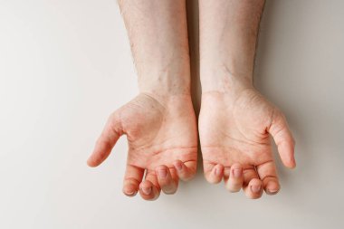 Erkek elleri beyaz masada, derisinde kırmızı lekeler var. Alerjik reaksiyon, deri problemleri, cilt bakımı. Yanlış diyet, ilaç almanın yan etkisi.