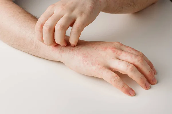 Erkek eller deride kaşındıran kırmızı noktalar çiziyor. Yanlış diyetten kaynaklanan alerji reaksiyonu, antibiyotik ya da ilaçların etkisi. Deri hastalığı