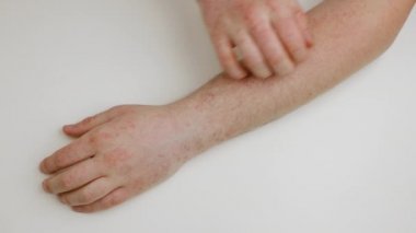 El, kolunda kırmızı kaşıntılı noktalar, antibiyotik, ilaç ve yanlış beslenme kaynaklı alerjik reaksiyon. Kaşıntı, mevsimsel alerji.