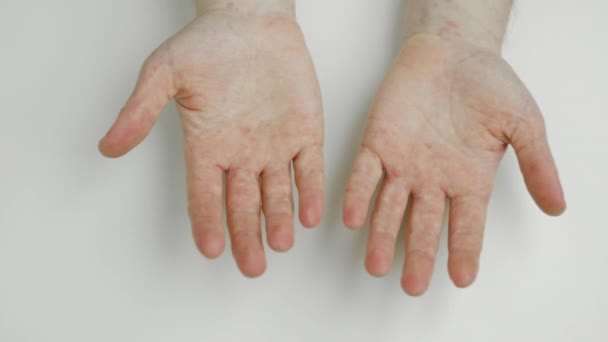 Άνθρωπος Δείχνει Παλάμες Χέρι Αλλεργική Αντίδραση Παρενέργεια Από Λήψη Φαρμάκων — Αρχείο Βίντεο