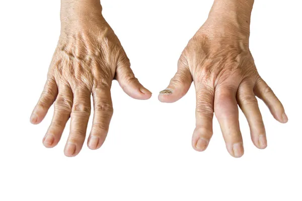 Artritis Van Hand Van Een Oude Vrouw Geïsoleerd Een Witte — Stockfoto