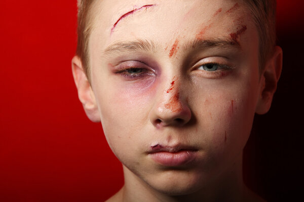 Beaten up kid