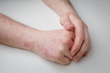 Alerji, beyaz masadaki erkek ellerinde kızarıklık. Dermatolojik sorun, hastanın deri semptomu. Yakın çekim.