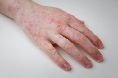 Alerji, beyaz masadaki erkek elinde kızarıklık. Dermatolojik sorun, hastanın deri semptomu. Yakın çekim.
