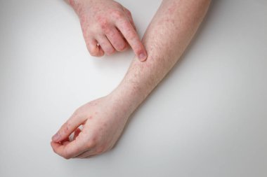 Hastanın ellerinde ve kollarında kızarıklık var. Deri iltihabı, egzama, dermatolojik sorun, deri tedavisi ve sağlık hizmetleri. Üst görünüm