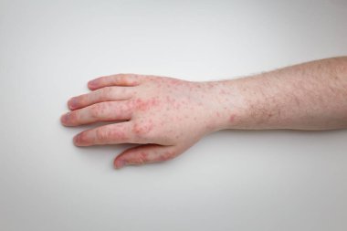Hasta kolunu ve elini kırmızı kaşıntılı ve ağrılı bir isilik ile gösteriyor. Erkek ellerindeki alerjik belirtiler. Dermatoloji, cilt bakımı. Beyaz arkaplan, üst görünüm