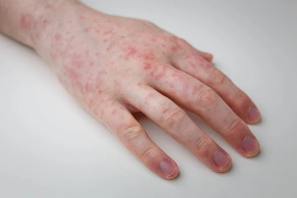 Allergia Eruzione Cutanea Pruriginosa Rossa Sulla Mano Maschile Sul Tavolo — Foto Stock