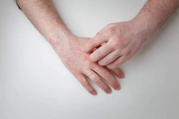 Fingers Scratching Hands Allergic Red Rash Derma Disease Painful Itchy — Fotografia de Stock