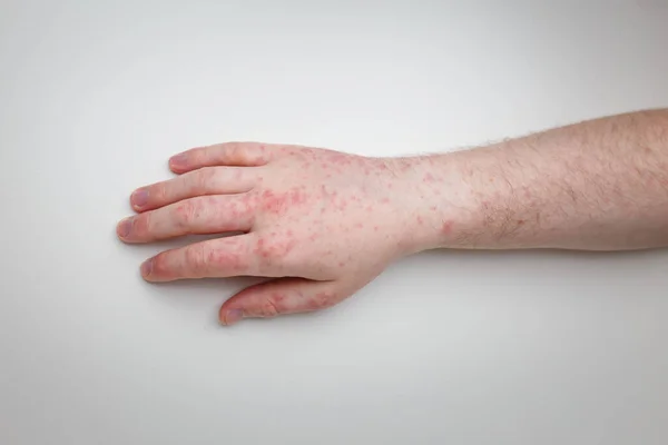 Patient Shows Arm Hand Red Itchy Painful Rash Allergic Symptom — Fotografia de Stock