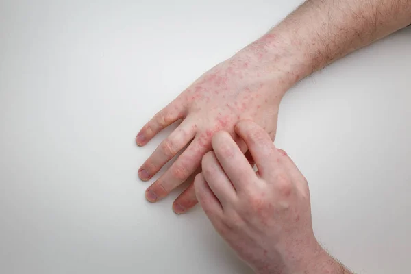 Δάχτυλα Ξύνοντας Χέρια Αλλεργικό Κόκκινο Εξάνθημα Νόσος Του Δέρματος Επώδυνες — Φωτογραφία Αρχείου