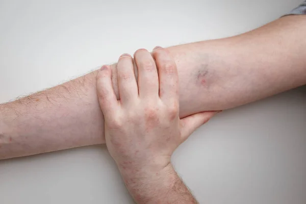 Male Arm Syringe Injection Mark Vaccine Reddening Reaction Rash Effect — Fotografia de Stock