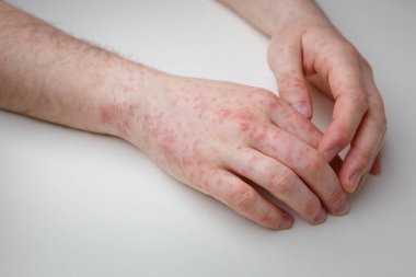 Alerji, beyaz masadaki erkek ellerinde kızarıklık. Dermatolojik sorun, hastanın deri semptomu. Yakın çekim.