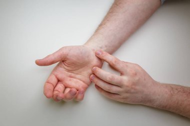 Hastanın bileğinde ve parmaklarında kızarıklık var. Dermatit, egzama, dermatolojik sorun, cilt tedavisi ve sağlık hizmetleri