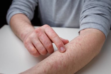Hastanın ellerinde ve kollarında kızarıklık var. Dermatit, egzama, dermatolojik sorun, cilt tedavisi ve sağlık hizmetleri