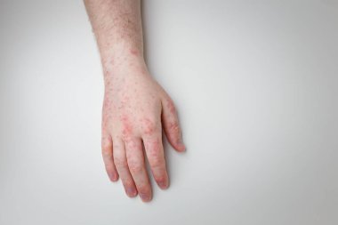 Kolu ve eli kırmızı kaşındıran kızarıklıklarla gösteren hasta. Erkek ellerindeki alerjik belirtiler. Dermatoloji, cilt bakımı. Beyaz arkaplan, üst görünüm