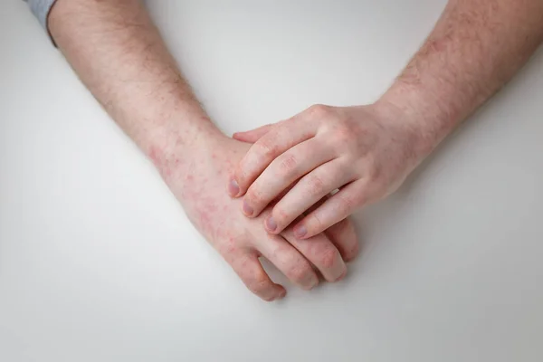 Fingers Scratching Hands Allergic Red Rash Derma Disease Painful Itchy — Fotografia de Stock