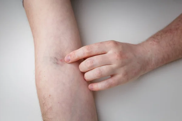 Patient Showing Syringe Injection Mark Arm Reddness Blue Vein Allergic — Fotografia de Stock