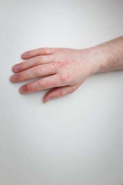 Hasta kolunu ve elini kırmızı kaşıntılı ve ağrılı bir isilik ile gösteriyor. Erkek ellerindeki alerjik belirtiler. Dermatoloji, cilt bakımı. Beyaz arkaplan, üst görünüm