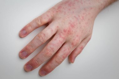 Alerji, beyaz masadaki erkek elinde kızarıklık. Dermatolojik sorun, hastanın deri semptomu. Yakın çekim.