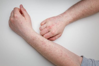 Alerji, erkek eli ve beyaz masadaki kollarda kızarıklık. Dermatolojik sorun, hastanın deri semptomu..