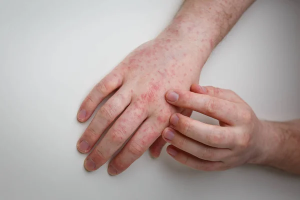 Finger Scratching Hands Allergic Red Rash Derma Disease Painful Itchy — Fotografia de Stock