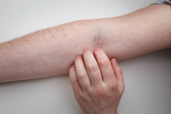 Пальцы Царапают Шприц Руке Симптом Зуда Руки Вакцинированного Пациента Белом — стоковое фото