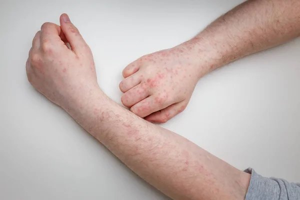 Allergy Red Itchy Rash Male Hands Arms White Table Dermatological — стоковое фото