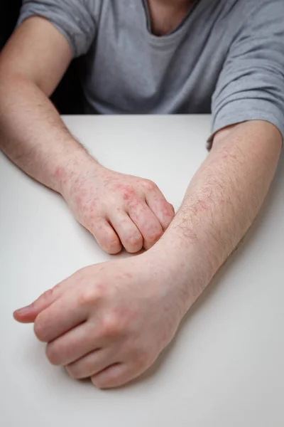 Allergia Vörös Viszkető Kiütés Férfi Kezeken Karokon Fehér Asztalon Bőrgyógyászati — Stock Fotó