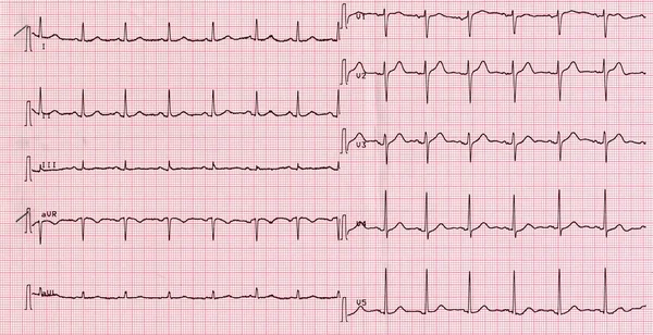 Eletrocardiografia do batimento cardíaco — Fotografia de Stock