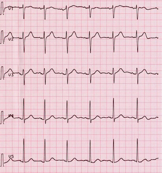 Eletrocardiografia do batimento cardíaco — Fotografia de Stock